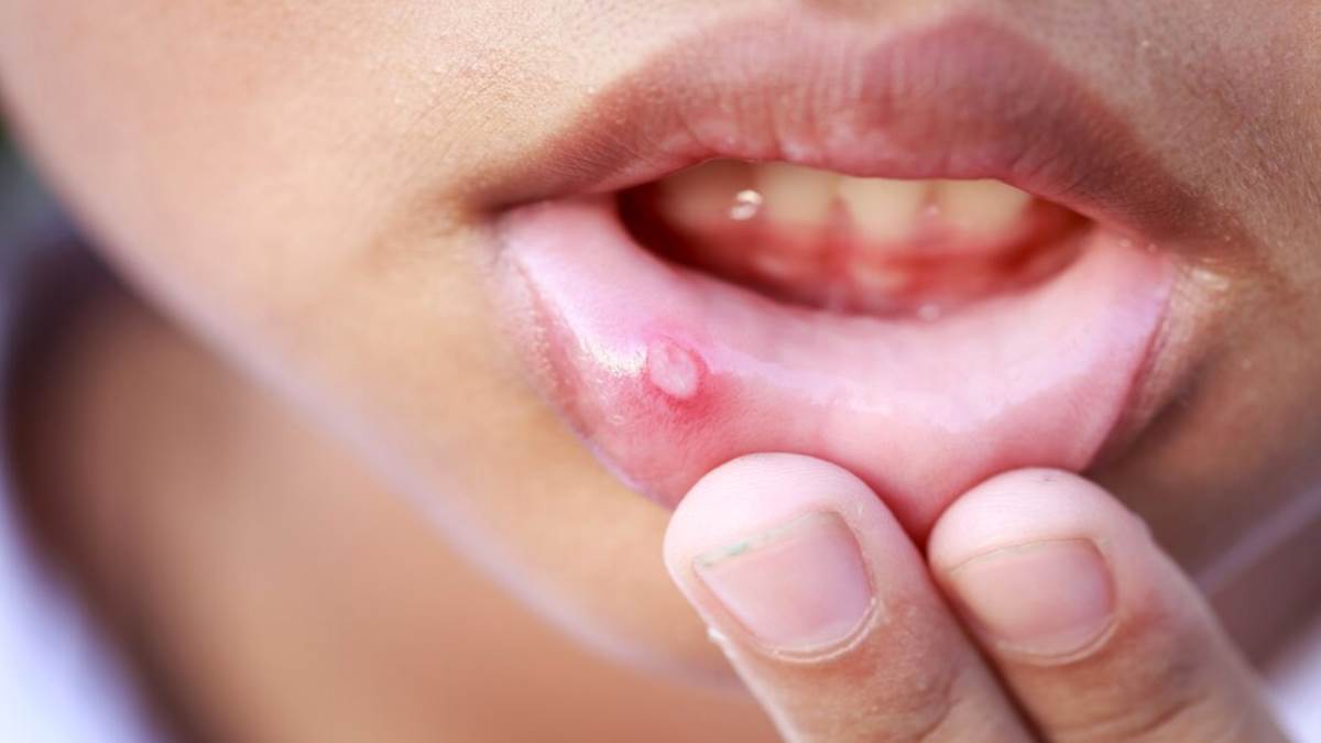 https://www.jagranimages.com/images/newimg/14112023/14_11_2023-mouth_ulcers_f_23579673_74739586.jpg
