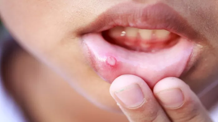 Mouth Ulcer Remedies: इन देसी नुस्खों से पाएं मुंह के छालों से राहत
