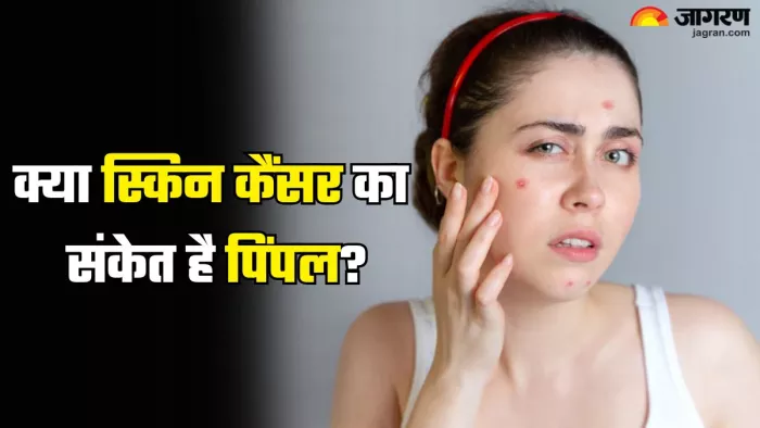 स्किन कैंसर का लक्षण निकला पिंपल (Picture Credit- Freepik)