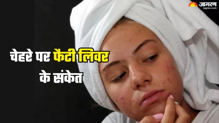 चेहरे पर नजर आते हैं फैटी लिवर के संकेत (Picture Credit- Freek)
