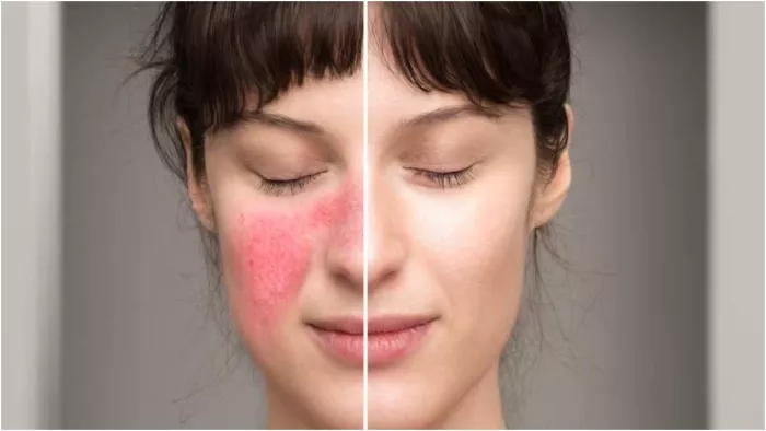 Face Redness Remedies: चेहरे की रेडनेस से हैं परेशान, तो ये 5 आसान आयुर्वेदिक उपाय आएंगे काम