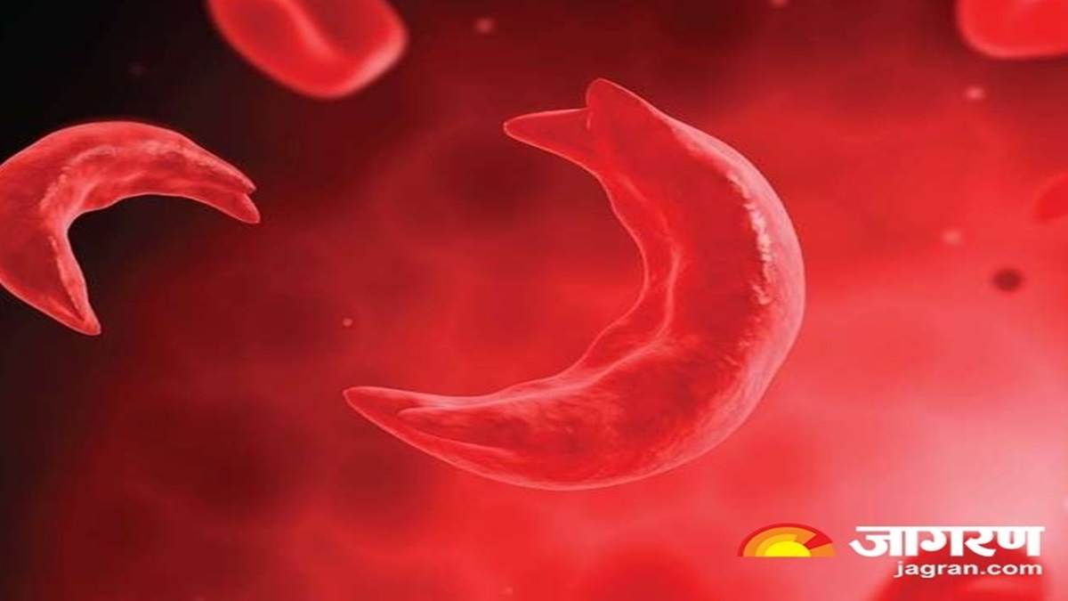 https://www.jagranimages.com/images/newimg/15032024/15_03_2024-sickle_cell_anemia_1_23675671.jpg