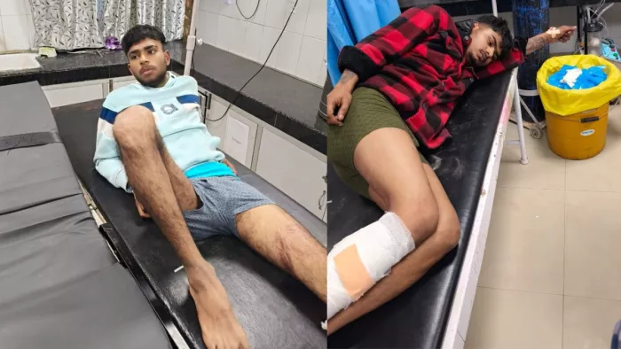 पुलिस मुठभेड़ के दौरान घायल हुए दोनों बदमाश