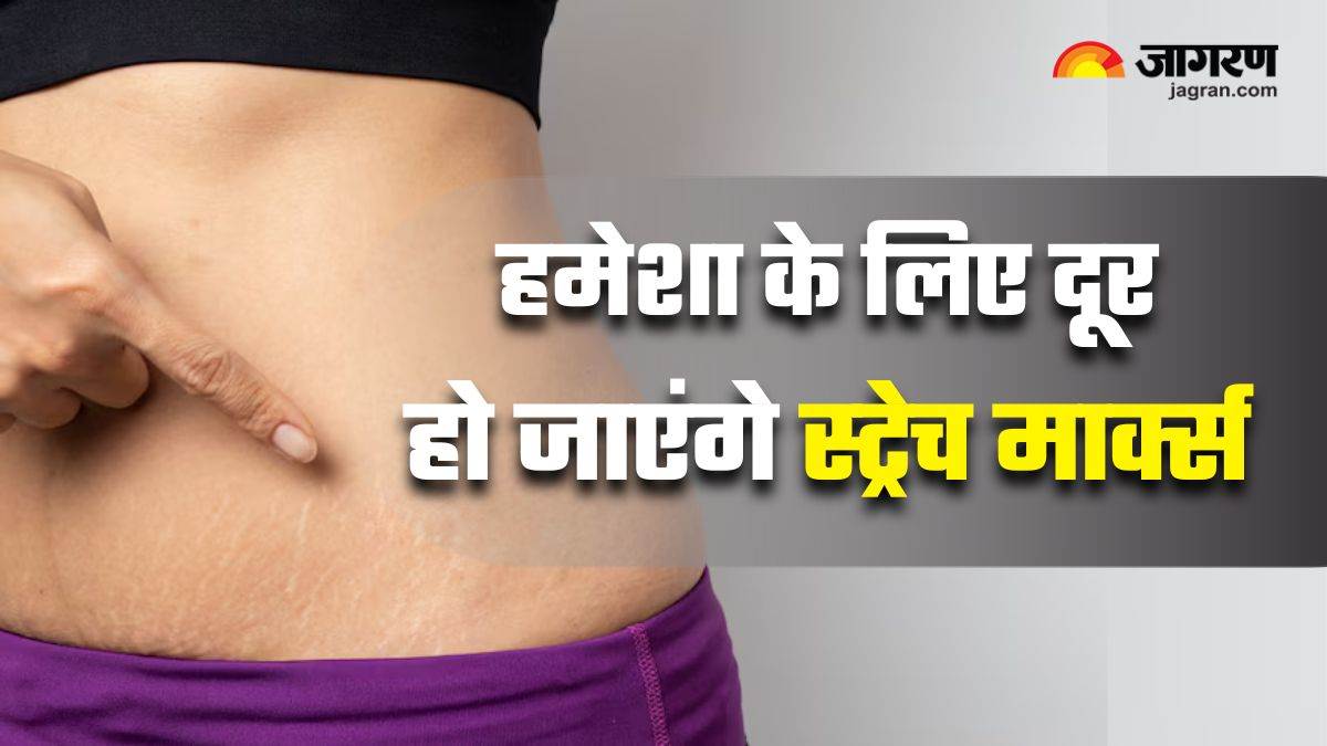 https://www.jagranimages.com/images/newimg/15042025/15_04_2025-natural_remedies_for_stretch_marks_23918743.jpg