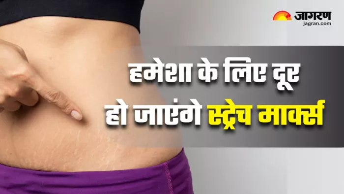 Stretch Marks को दूर करने के लिए अपनाएं ये 3 घरेलू नुस्खे (Image Source: Freepik)