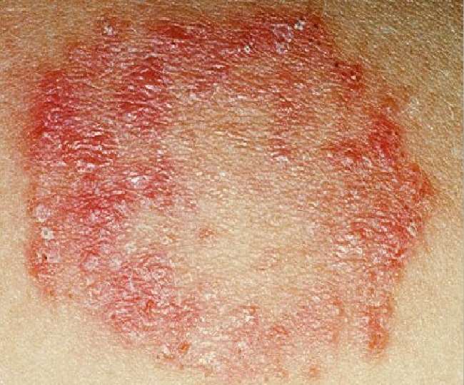 https://www.jagranimages.com/images/newimg/15052022/15_05_2022-fungal_infection_22714893_1915282.jpg