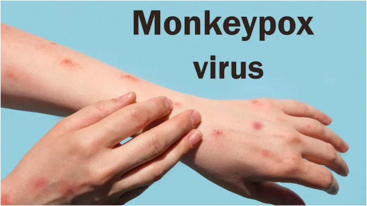 Monkeypox: भारत में मंकीपॉक्स का पहला मामला केरल में, जानें लक्षण और कैसे कर सकते हैं बचाव