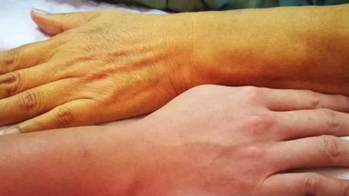https://www.jagranimages.com/images/newimg/15092025/15_09_2025-kupwara_jaundice_outbreak_24048114.jpg