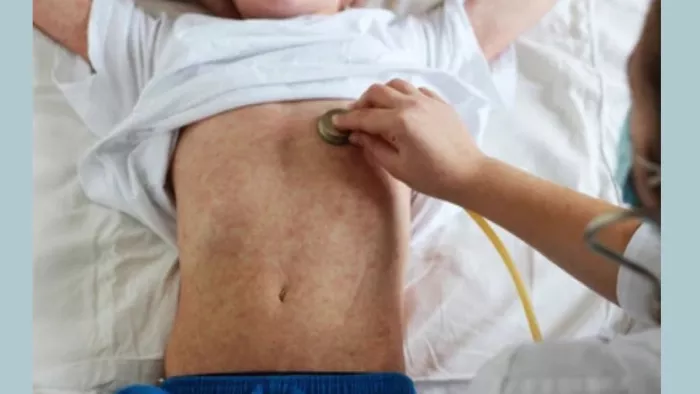 Measles Outbreak in Mumbai: मुंबई में खसरे का प्रकोप बढ़ता ही जा रहा है