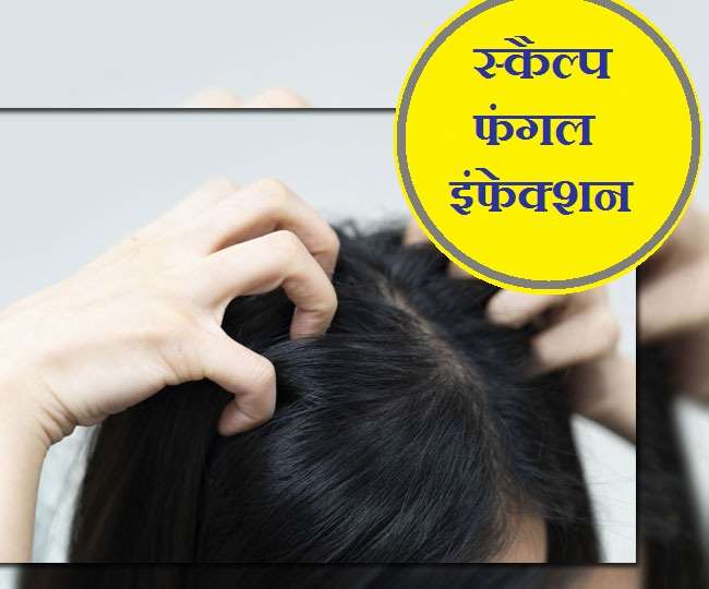 Scalp Fungal Infection: सिर के फंगल इंफेक्शन से हैं परेशान, तो आज़माएं ये 6 जादुई उपाय! - Tired Of Scalp Fungal Infection Then Follow 6 Magical Home Remedies Scalp Fungal Infection: सिर के फंगल इंफेक्शन से हैं परेशान, तो आज़माएं ये 6 जादुई उपाय! - Tired Of Scalp Fungal Infection Then Follow 6 Magical Home Remedies