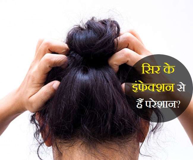 How to Treat Fungal Infections in your Scalp  Be Beautiful India