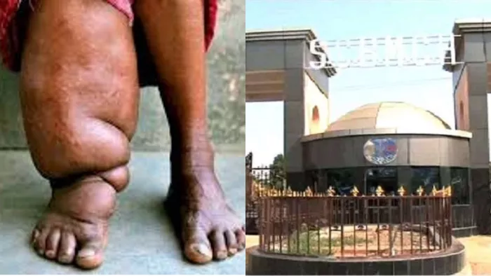 एससीबी मेडिकल में पहली बार फाइलेरिया मरीज का हुआ सफल ऑपरेशन