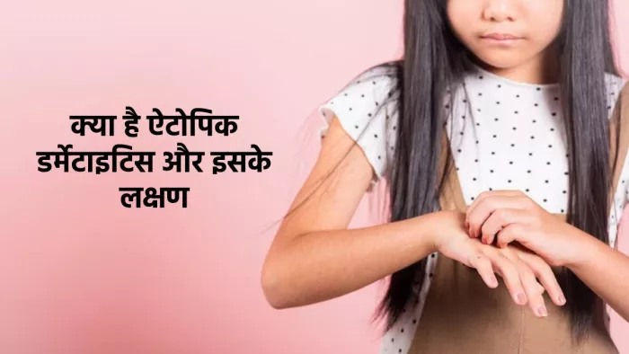 Skin Problem: एटोपिक डर्मेटाइटिस के लक्षण, उपचार व बचाव