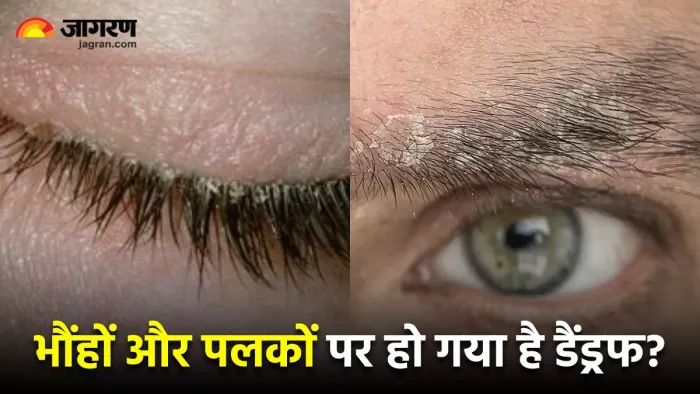 भौंहों और पलकों पर होने वाले डैंड्रफ को दूर करेंगे ये 3 घरेलू नुस्खे (Image Source: Freepik)