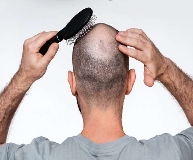 https://www.jagranimages.com/images/newimg/16082020/16_08_2020-alopecia_areata_20631829_2161982.jpg