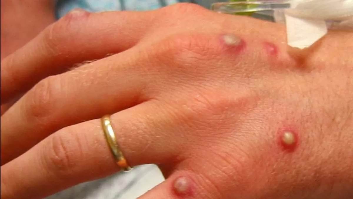 https://www.jagranimages.com/images/newimg/16082024/16_08_2024-monkeypox_23779238.jpg