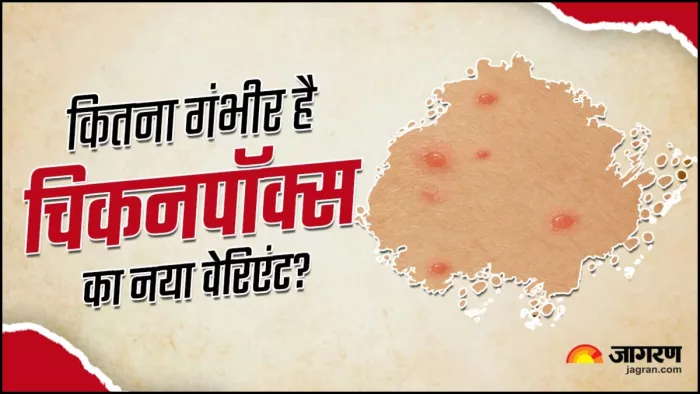 जानें चिकनपॉक्स के नए वेरिएंट के बारे में सबकुछ