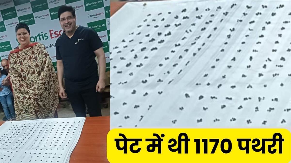 ncr doctors performed surgery and removed 1170 stones from woman stomach at fortis hospital in faridabad