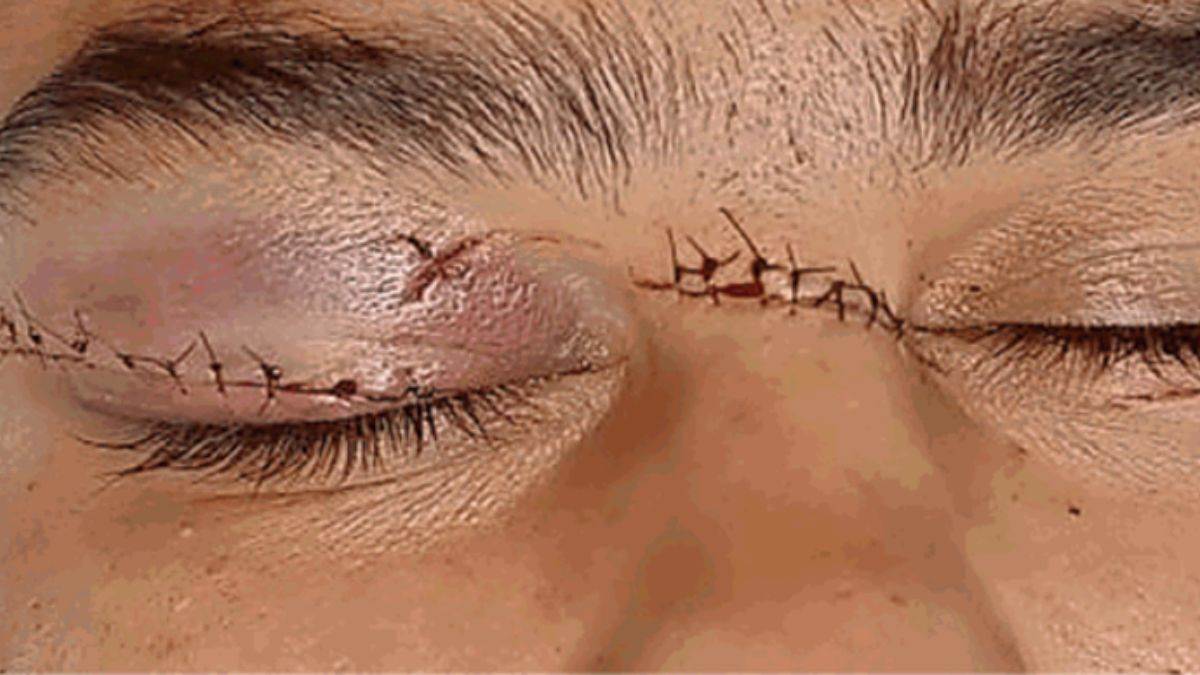 Ludhiana News: प्लास्टिक डोर से स्कूटर सवार युवक का चेहरा कटा, लगे 20 टांके  - Ludhiana News Scooter riders face cut with plastic cord got twenty  stitches