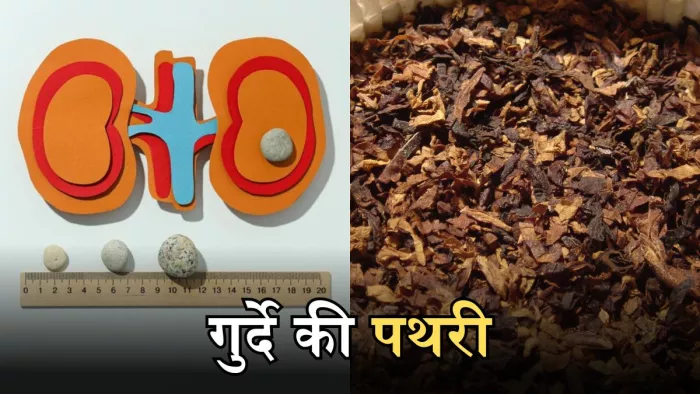 गुर्दे की पथरी को 2 सेमी से ज्यादा बड़ा कर सकता है पान मसाला का सेवन