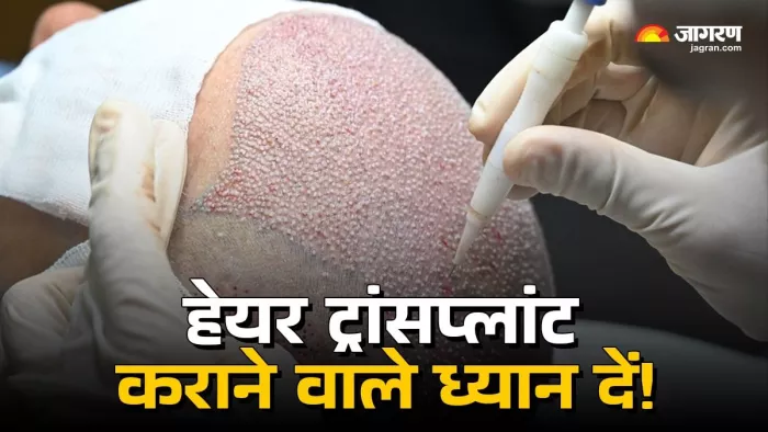Hair Transplant में जरा सी चूक बन रही मौत का कारण