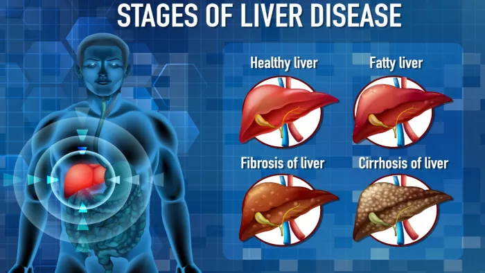 World Liver Day: नॉन एल्कोहोलिक स्टेटोहेपटाइटिस (नैश), जानें इसके लक्षण व उपचार