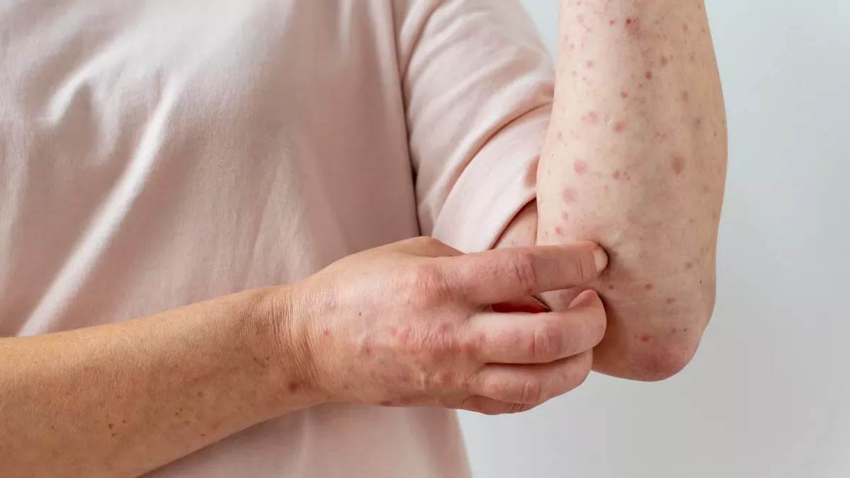 https://www.jagranimages.com/images/newimg/17052025/17_05_2025-09_05_2023-scabies_skin_infection_f_23406977_23939950.jpg