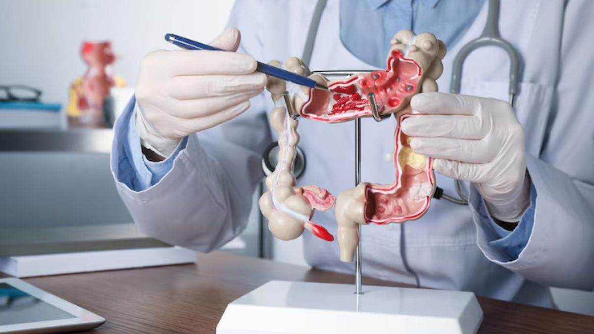 https://www.jagranimages.com/images/newimg/17062025/17_06_2025-colorectal_cancer_23966047.jpg