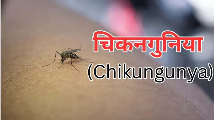 जानें चिकनगुनिया से जुड़ी सभी जरूरी जानकारी