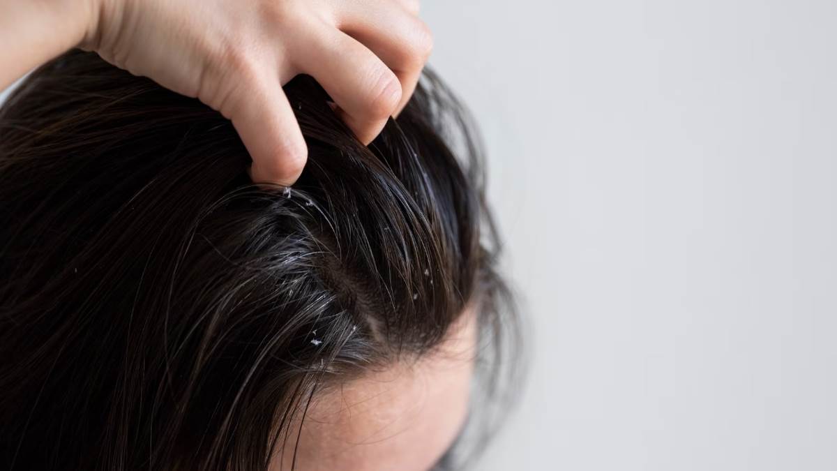 remedies to get rid of scalp fungus in monsoon