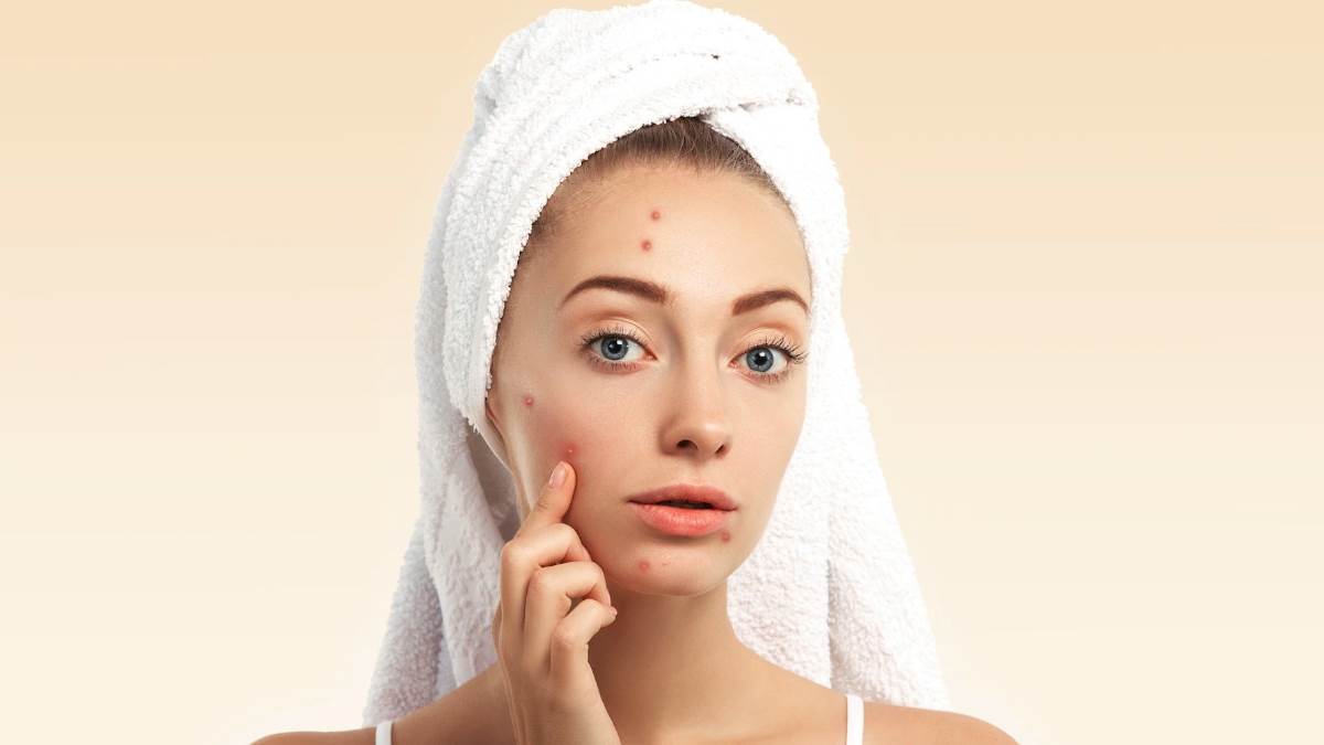 https://www.jagranimages.com/images/newimg/17082022/17_08_2022-pimples_home_remedies_f_22984628.jpg