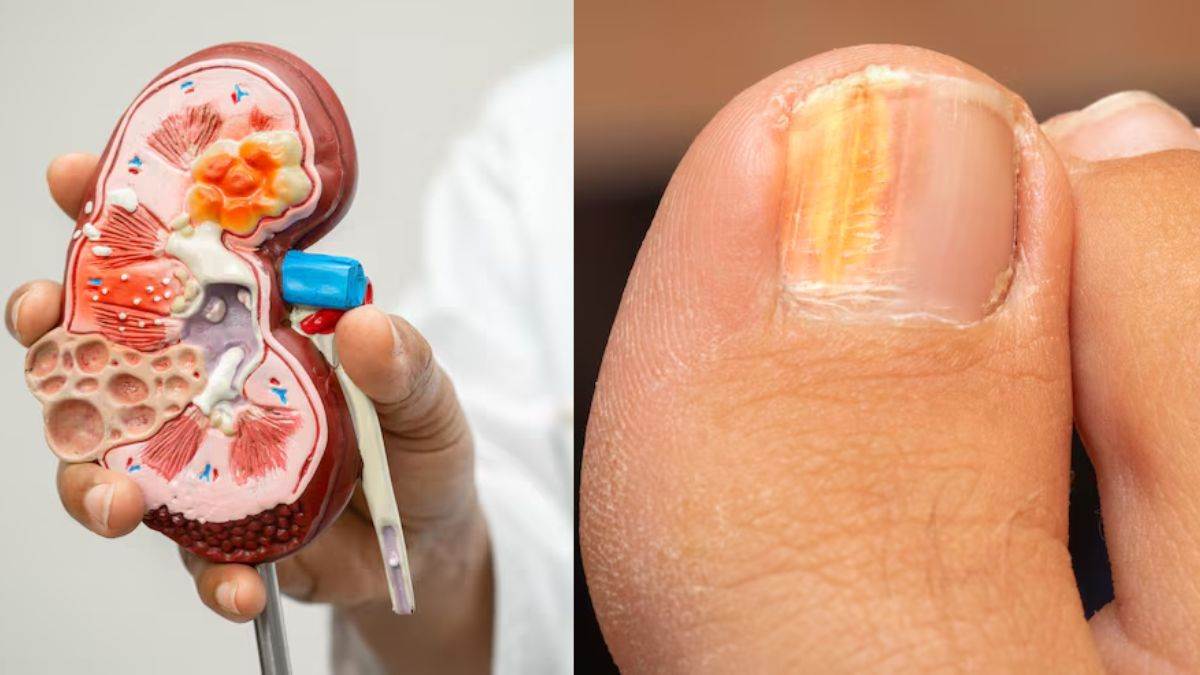 https://www.jagranimages.com/images/newimg/17082025/17_08_2025-kidney_disease_symptoms_24015496.jpg