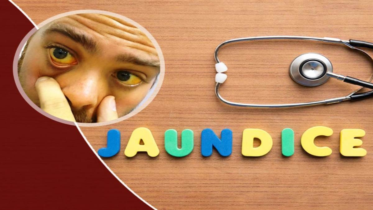 varanasi news waterborne diseases increase children affected by jaundice