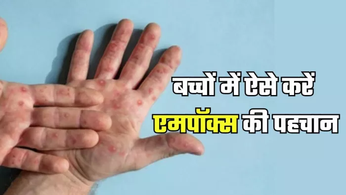 बच्चों में ऐसे करें एमपॉक्स की पहचान (Picture Credit- Freepik)