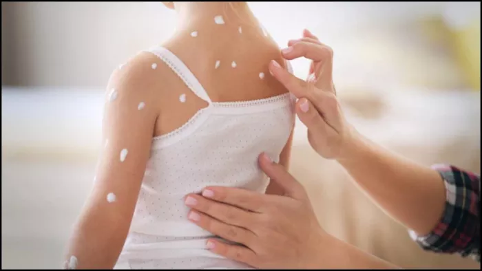 Measles: खसरा, चिकनपॉक्स और स्मॉलपॉक्स कैसे एक-दूसरे से अलग, जानें इनके लक्षण