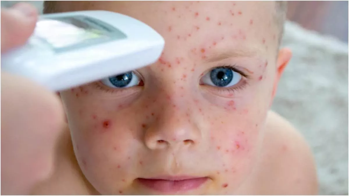 Measles Outbreak: बच्चों में खसरा के मामले अचानक क्यों बढ़ रहे हैं? जानें  क्या कहना है डॉक्‍टर्स का - What Is The Reason Behind Sudden Outbreak Of  Measles Among Children