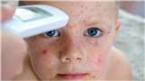 Measles Outbreak: जानें डॉक्टर्स से क्यों अचानक बढ़ रहे हैं बच्चों में खसरा के मामले?