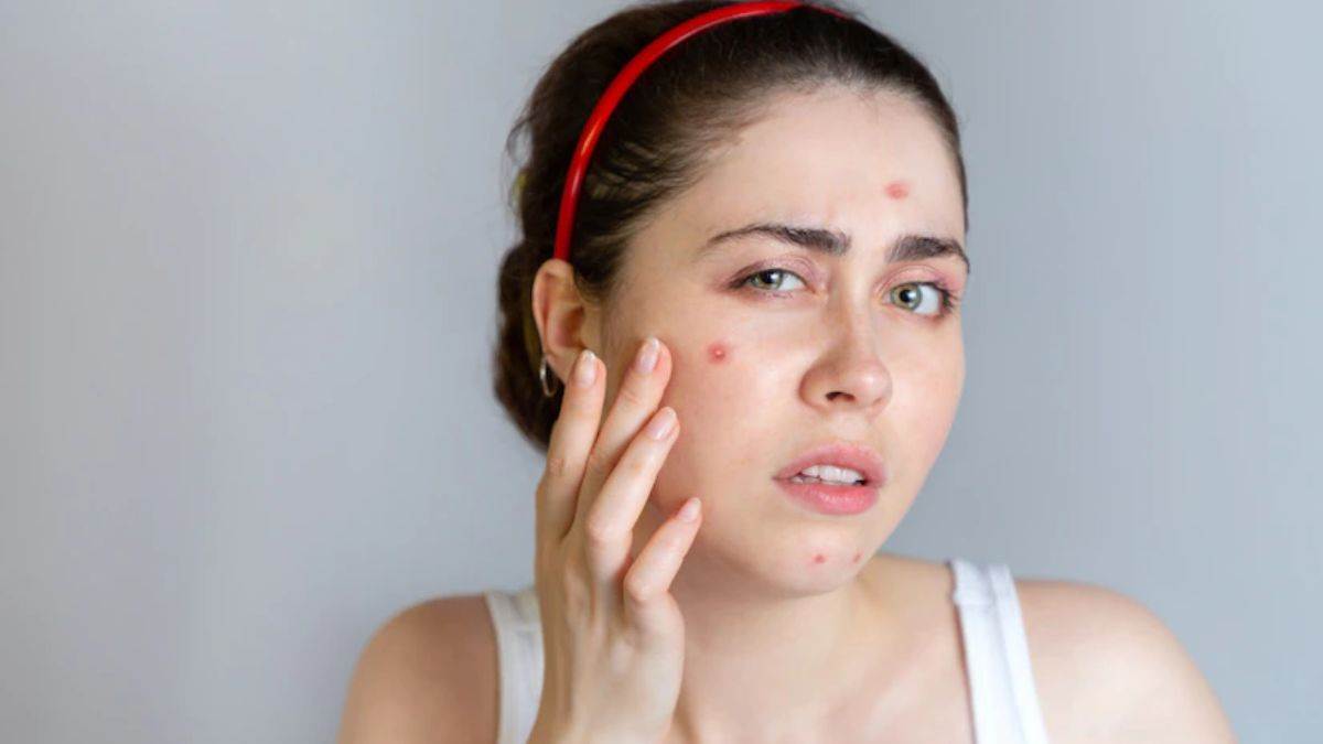 Skin Care Tips इन 5 आदतों की वजह से होते हैं चेहरे पर कीलमुंहासे