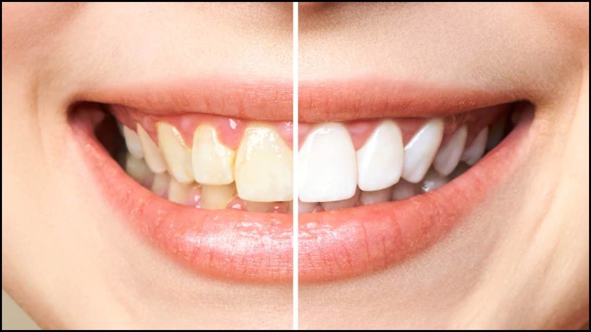 https://www.jagranimages.com/images/newimg/18012023/18_01_2023-teeth_23300351.jpg
