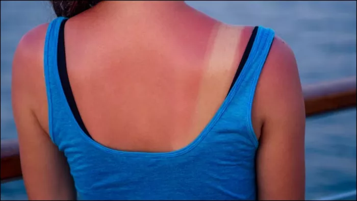 Sunburn Home Remedies: सनबर्न में जल्द राहत देंगी घर पर मौजूद ये 5 चीजें