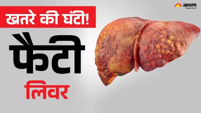 डायबिटीज के बाद साइलेंट किलर बन रहा फैटी लिवर