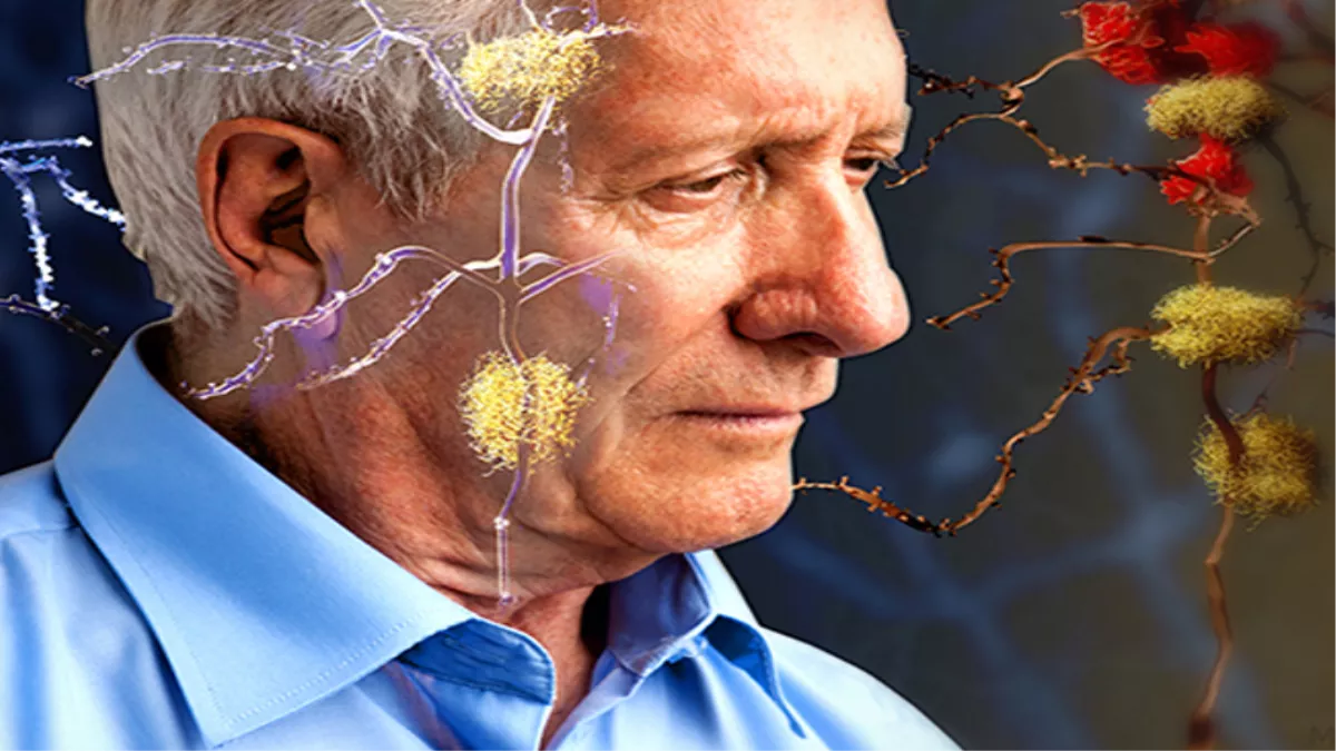 Alzheimer disease treatment : अल्जाइमर की बीमारी से लड़ने में मददगार हो सकता है इस पौधे के तने का अर्क