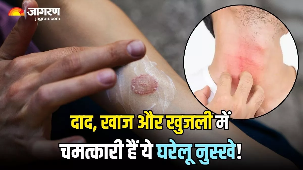 Home Remedies For Ringworm: दाद, खाज और खुजली की समस्या में रामबाण हैं ये घरेलू नुस्खे, तुरंत मिलेगा आराम!