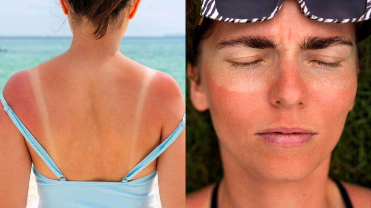 https://www.jagranimages.com/images/newimg/18052025/18_05_2025-sun_burn_vs_sun_tan_23940295.jpg