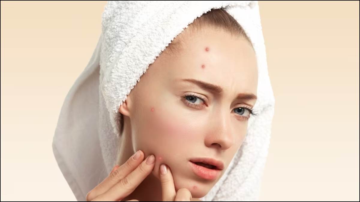 https://www.jagranimages.com/images/newimg/18072023/18_07_2023-pimples_23475148.jpg