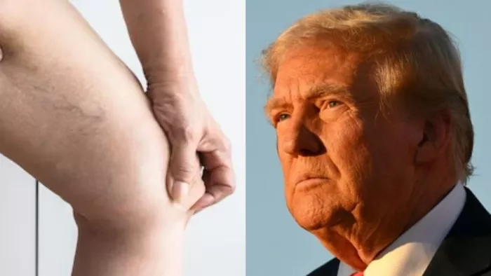 Donald Trump को हुई ये बीमारी (Image Credit- X/Freepik)