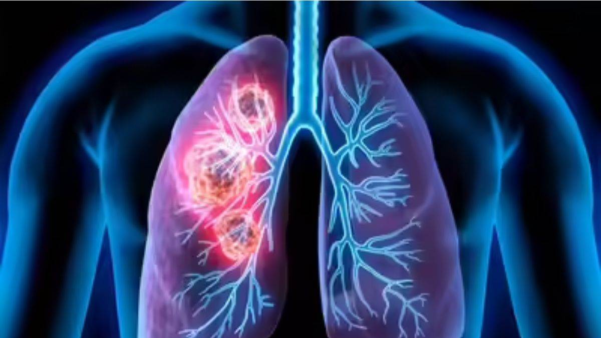 https://www.jagranimages.com/images/newimg/18072025/18_07_2025-pollution-effect-lungs-news_23987858.jpg