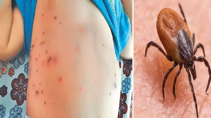 बिहार में बढ़ा रहस्यमयी स्क्रब ...