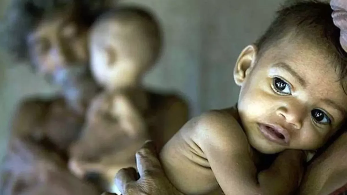 ओडिशा के 12 जिलों में कुपोषण दर राष्ट्रीय से अधिक