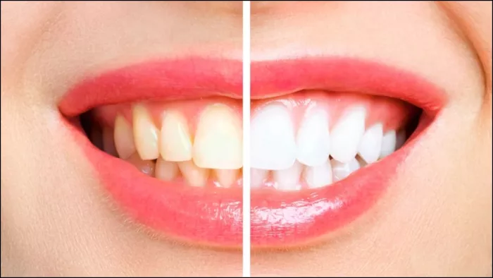 World Oral Day 2023: पीले दांतों की समस्या से छुटकारा पाने के लिए खाएं ये फल